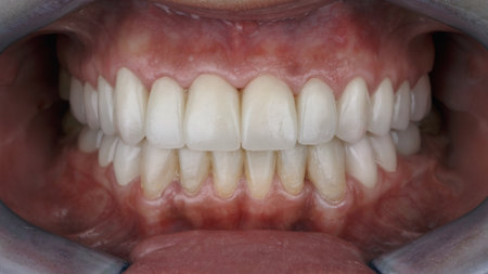 excellent dental photo with temporary plastic crowns in the oral cavityの写真素材