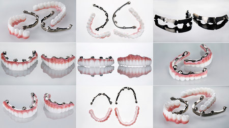 dental collage of different photos of two prostheses and titanium bars in different compositions on a white backgroundの写真素材
