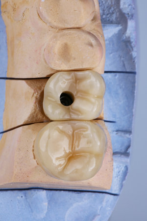 two dental zircon crowns with morphology on the model top view