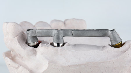 cobalt chromium dental bar on a model for a temporary prosthesisの写真素材