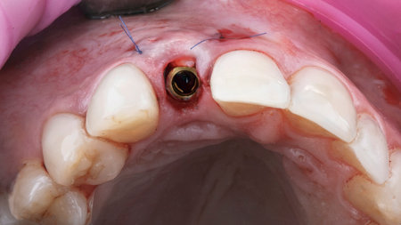 gum cavity with installed dental abutment and sutured soft tissue flap in the gumの写真素材