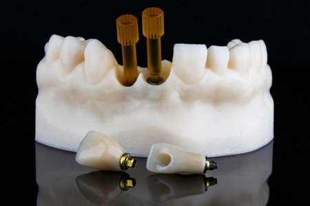 dental model with two crowns lying side by side on a black background