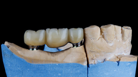 dental bridge prosthesis for three teeth from zircon on a plaster model on a black background