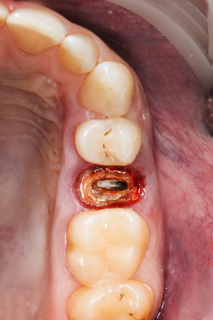 decayed tooth root for removal and implantationの写真素材
