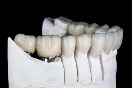 dental model of the lower jaw with ceramic crowns and veneers on a black backgroundの写真素材