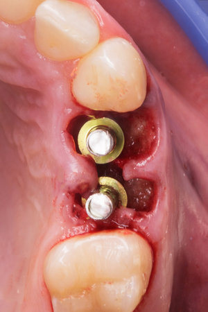 two dental abutments after implantationの写真素材