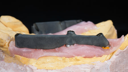 dental bar made of coated titanium with silicone gum on the model