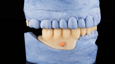 scan dental lower jaw prosthesis on a plaster model, side view on a black backgroundの写真素材