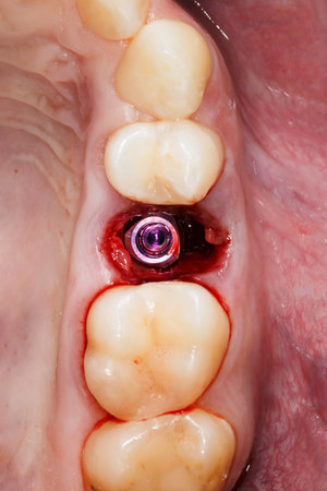 oral cavity with one installed dental implantの写真素材