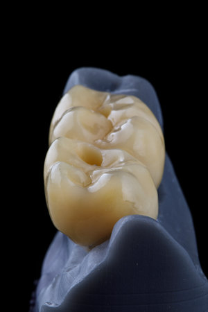 two dental crowns of chewing teeth from zircon with morphology on a model on a black background