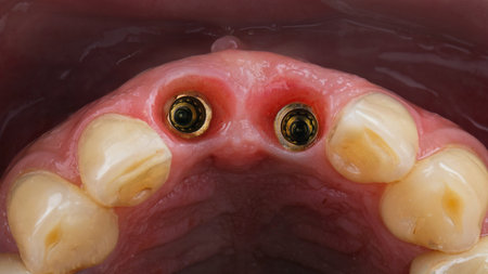 excellent gingival cavity with two dental implants, view through the distal mirrorの写真素材