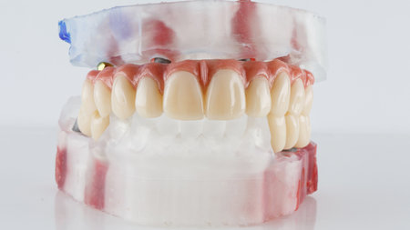 temporary dental prosthesis of the upper jaw and bridges on the model, on a white backgroundの写真素材
