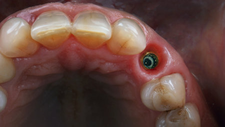 composition of the installed dental implant before installing the crownの写真素材