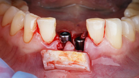 mandible with two gingiva formers and soft tissue flap