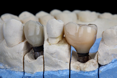 two dental crowns of different natural colors on a plaster modelの写真素材