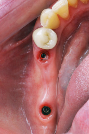 beautifully healed gum cavity for the installation of a dental bridge in the chewing area