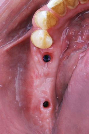 reconstructed gingival cavity after implantation before placing a bridge made of zirconium or ceramicの写真素材