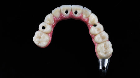 ceramic dental prosthesis on a titanium bar top view with the morphology of the teeth on a black...