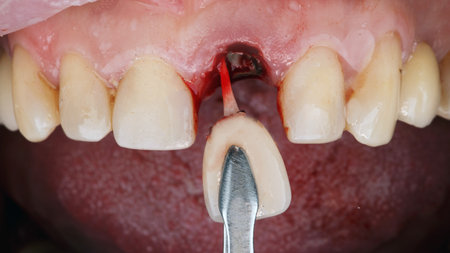 removal of the central tooth with a post made of carbon material followed by implantationの写真素材