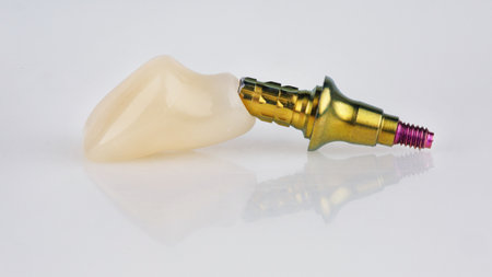 temporary dental crown of the central tooth with a golden color abutment on a white backgroundの写真素材