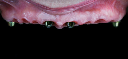 beautiful maxillary gum with pink gum with four implants placed before prosthesis