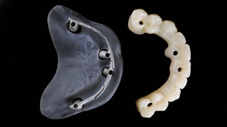 beautiful composition of a dental prosthesis made of polymer and a model with a metal bar, top view on a black backgroundの写真素材