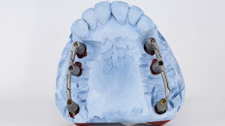 plaster model with two metal dental beams on a white background