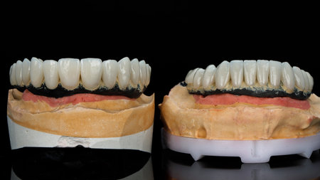 two models with titanium dental prostheses and ceramic crowns on a black background
