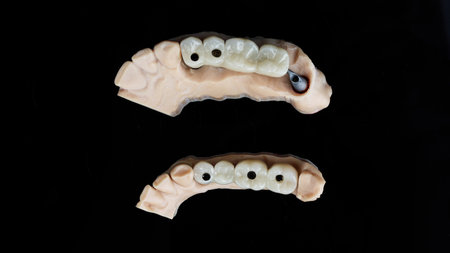 two dental prosthesis bridges on beams and models, top view on a black backgroundの写真素材