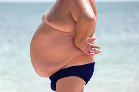 Man with belly. Obese male outdoors. Serious health problem. High risk of hernias.
