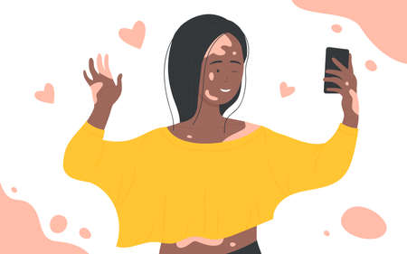 Skin problems vitiligo vector illustration. Cartoon happy girl character using mobile phone to make selfie for social media. Support people with vitiligo, body positive conceptのイラスト素材