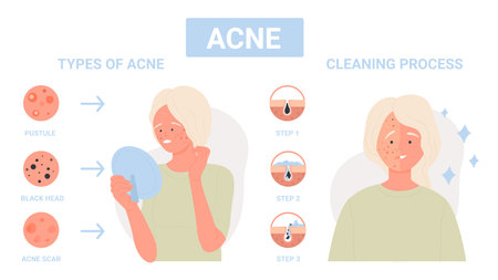 Type of acne on facial skin, steps of infection treatment for face pores infographic flat vector illustration. Cartoon girl with dermis problem of inflammation, scars. Medicine, skincare conceptのイラスト素材