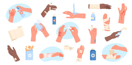 Injured hands set vector illustration. Cartoon isolated human arms with wounds and burn on body skin, cleaning and dressing with bandages, applying medical treatment for injury, first aid for traumaのイラスト素材