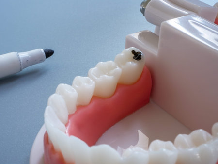 Model of a human jaw and tooth marked as a sign of caries. Dental treatment.
