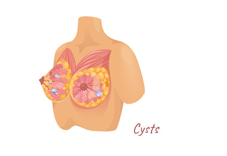 Concept Mammary glands female breast with cysts. The illustration is a flat design vector of the anatomy of the female breast, showcasing a cartoon depiction of cysts. Vector illustration.のイラスト素材