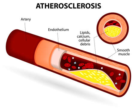 atherosclerosis. Artery wall thickens as a result of the accumulation of calcium, fat and cholesterol. It reduces the elasticity of the artery. のイラスト素材