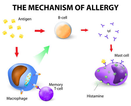 Mechanism of allergy. のイラスト素材