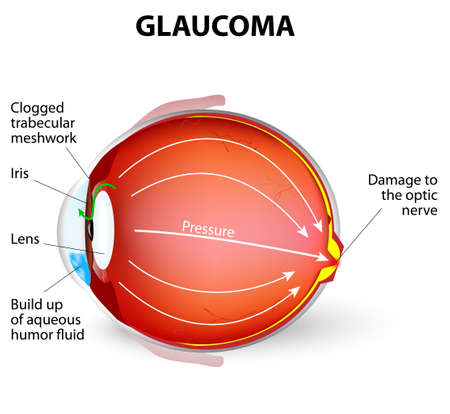 Glaucoma is an eye disease and a leading cause of blindness. The optic nerve is injured. The intra-ocular pressure is increasedのイラスト素材