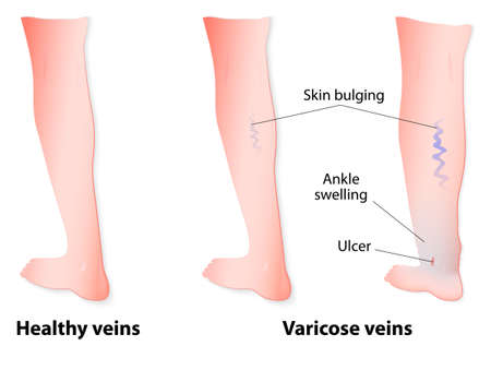 Varicose veins are twisted and enlarged veins blue in color linked to faulty valves. In some of the cases, the veins may go on to rupture or ulcers may form. Vector diagramのイラスト素材