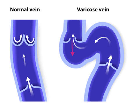 healthy vein and Varicose vein. human veins. Vector diagramのイラスト素材