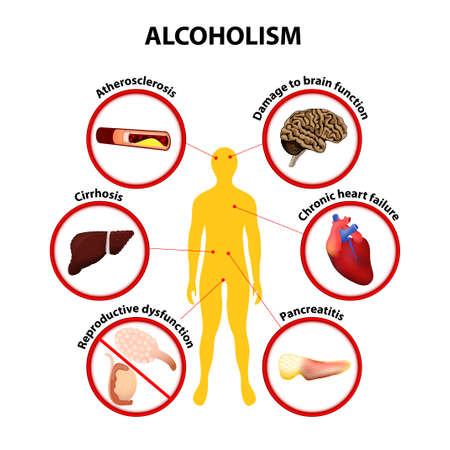 Alcoholism infographicのイラスト素材