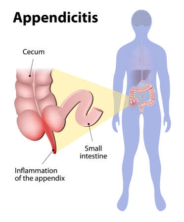 Appendicitis is inflammation of the appendix. Large intestine and appendix highlighted on the silhouette of a human. medical illustrationのイラスト素材