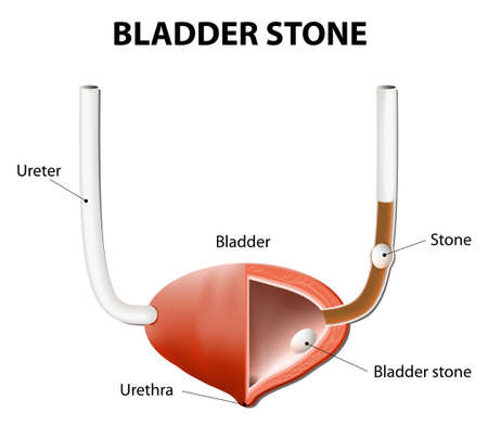 Stones in the urinary bladder and ureter. human anatomy. illustration of the urinary bladder cross sectionのイラスト素材