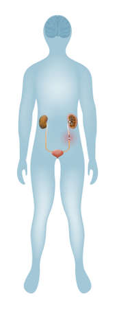 Urolithiasis. kidney stones or renal calculus. Kidney and Bladder highlighted on the silhouette of a humanのイラスト素材