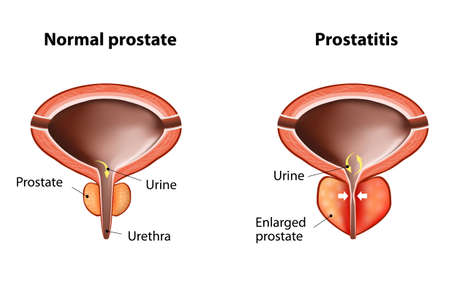 normal prostate and acute prostatitis. Medical illustrationのイラスト素材