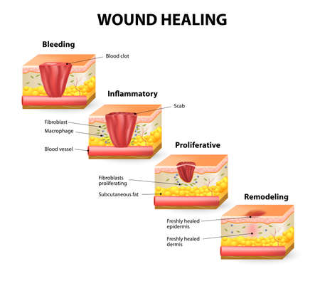 Phases of the wound healing process. Hemostasis, Inflammatory, Proliferative, Maturation and remodeling phaseのイラスト素材