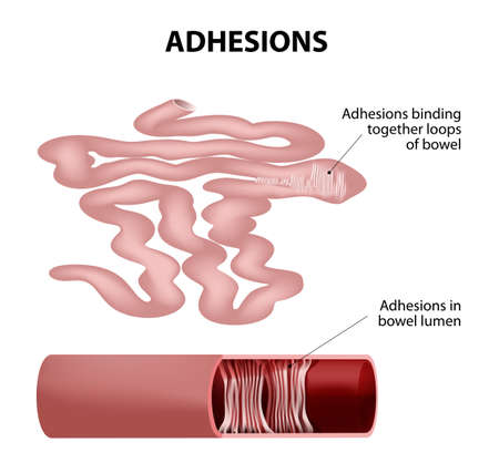 Adhesions.Human small intestine. Adhesions are scar tissue that forms between two organs that are not normally connected to each other. part of small intestine taken out.のイラスト素材
