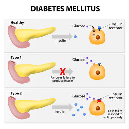 Main types of diabetes mellitus. Either the pancreas not producing enough insulin or the cells of the body not responding properly to the insulin produced