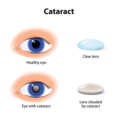 A cataract is an clouding crystalline lens inside the eye.のイラスト素材