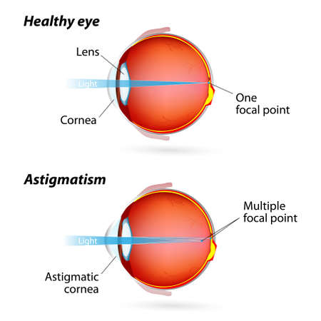 Astigmatism. Eye disease. Healthy eye and Astigmatic eyeのイラスト素材
